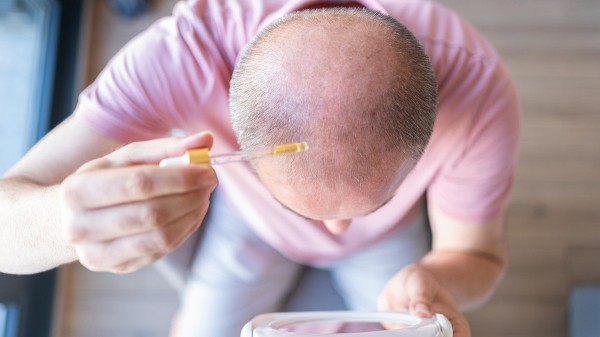 New baldness treatment shows dramatic hair-regrowth gains in major trial