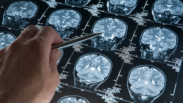 Sharpen memory and fight brain fog with simple 60-second trick from a neurologist