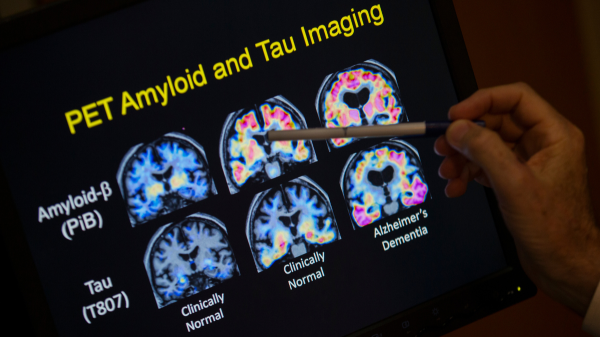 10 health conditions may be linked to Alzheimer's years before diagnosis