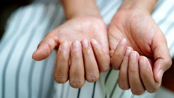 People on weight-loss drugs report fingernails falling off as researchers uncover surprising link People on weight-loss drugs report fingernails falling off as researchers uncover surprising link