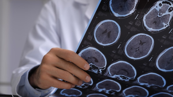 Brain-infecting fungus that can kill 7 in 10 patients is on the rise across America Brain-infecting fungus that can kill 7 in 10 patients is on the rise across America